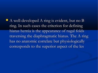  A well-developed A ring is evident, but no BA well-developed A ring is evident, but no B
ring. In such cases the criterion for definingring. In such cases the criterion for defining
hiatus hernia is the appearance of rugal foldshiatus hernia is the appearance of rugal folds
traversing the diaphragmatic hiatus. The A ringtraversing the diaphragmatic hiatus. The A ring
has no anatomic correlate but physiologicallyhas no anatomic correlate but physiologically
corresponds to the superior aspect of the lescorresponds to the superior aspect of the les
 