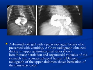  A 4-month-old girl with a paraesophageal hernia who
presented with vomiting. A Chest radiograph obtained
during an upper gastrointestinal series shows
intrathoracic herniation and organoaxial volvulus of the
stomach into a paraesophageal hernia. b Delayed
radiograph of the upper abdomen shows herniation of
the transverse colon
 
