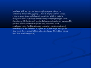 Newborn with a congenital short esophagus presenting with
respiratory distress and gagging. a Chest radiograph shows a large
cystic structure in the right hemithorax within which is coiled a
nasogastric tube. Note a lens-shape density overlying the right lower
chest (arrows) b Radiograph obtained after administration of watersoluble
contrast material via the nasogastric tube confirms a short
esophagus with a fixed intrathoracic stomach. Note the malfixated
small bowel in the abdomen. c Sagittal T2-W MR image through the
right chest shows a small additional posterolateral (Bochdalek) hernia
with liver herniation (arrow)
 