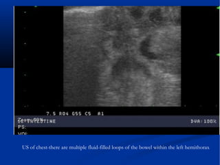 US of chest-there are multiple fluid-filled loops of the bowel within the left hemithorax
 