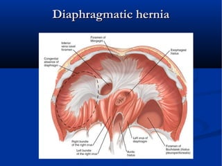 Diaphragmatic herniaDiaphragmatic hernia
 
