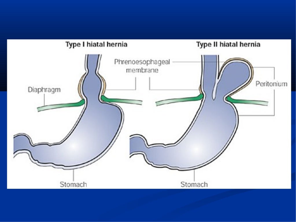 Diaphragmatic hernia