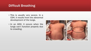Difficult Breathing
▪ This is usually very severe. In a
CDH, it results from the abnormal
development of the lungs.
▪ In an ADH, it occurs when the
lungs can’t function properly due
to crowding.
 