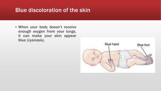 Blue discoloration of the skin
▪ When your body doesn’t receive
enough oxygen from your lungs,
it can make your skin appear
blue (cyanosis).
 
