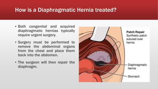 How is a Diaphragmatic Hernia treated?
▪ Both congenital and acquired
diaphragmatic hernias typically
require urgent surgery.
▪ Surgery must be performed to
remove the abdominal organs
from the chest and place them
back into the abdomen.
▪ The surgeon will then repair the
diaphragm.
 