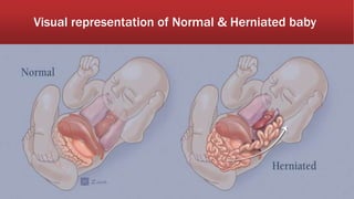 Visual representation of Normal & Herniated baby
 