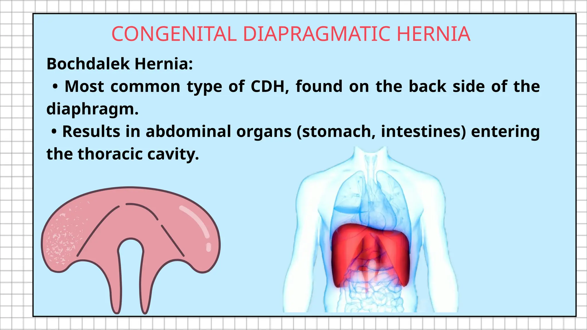 Diaphragmatic Hernia: Understanding the Anatomy, Diagnosis, and ...