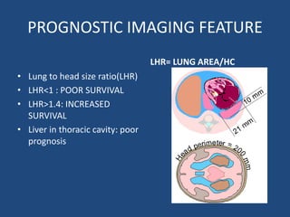 PROGNOSTIC IMAGING FEATURE
• Lung to head size ratio(LHR)
• LHR<1 : POOR SURVIVAL
• LHR>1.4: INCREASED
SURVIVAL
• Liver in thoracic cavity: poor
prognosis
LHR= LUNG AREA/HC
 