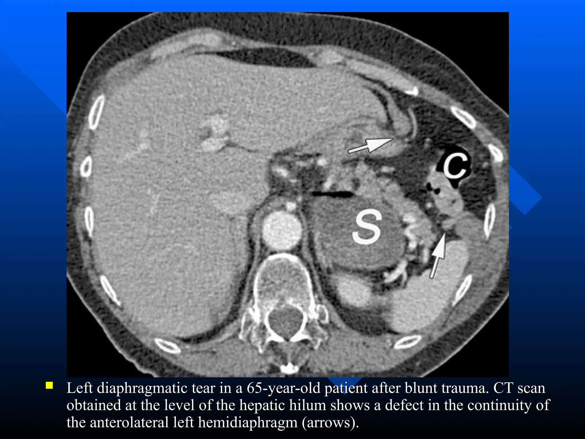  Left diaphragmatic tear in a 65-year-old patient after blunt trauma. CT scan
Left diaphragmatic tear in a 65-year-old patient after blunt trauma. CT scan
obtained at the level of the hepatic hilum shows a defect in the continuity of
obtained at the level of the hepatic hilum shows a defect in the continuity of
the anterolateral left hemidiaphragm (arrows).
the anterolateral left hemidiaphragm (arrows).
 