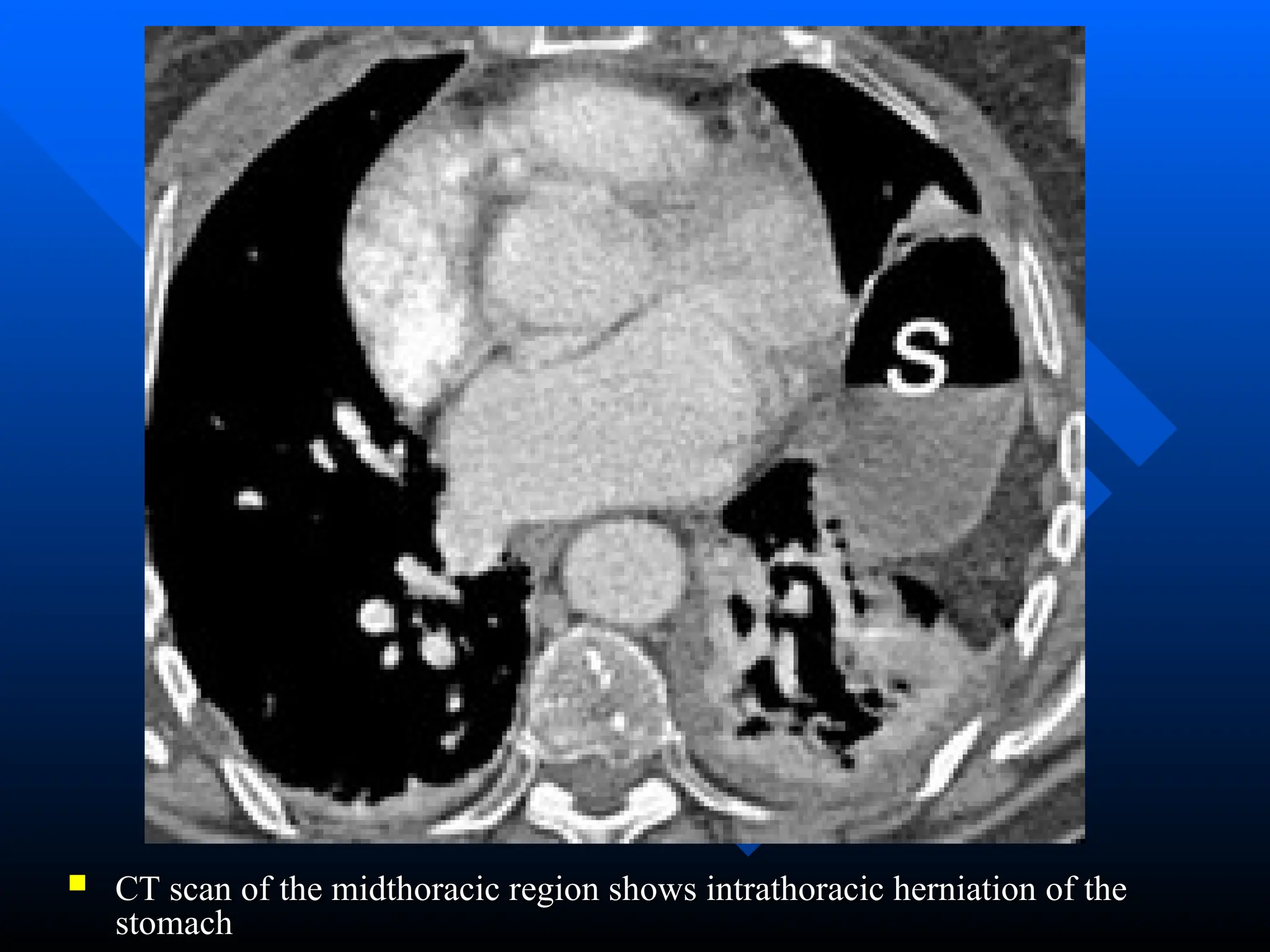  CT scan of the midthoracic region shows intrathoracic herniation of the
CT scan of the midthoracic region shows intrathoracic herniation of the
stomach
stomach
 