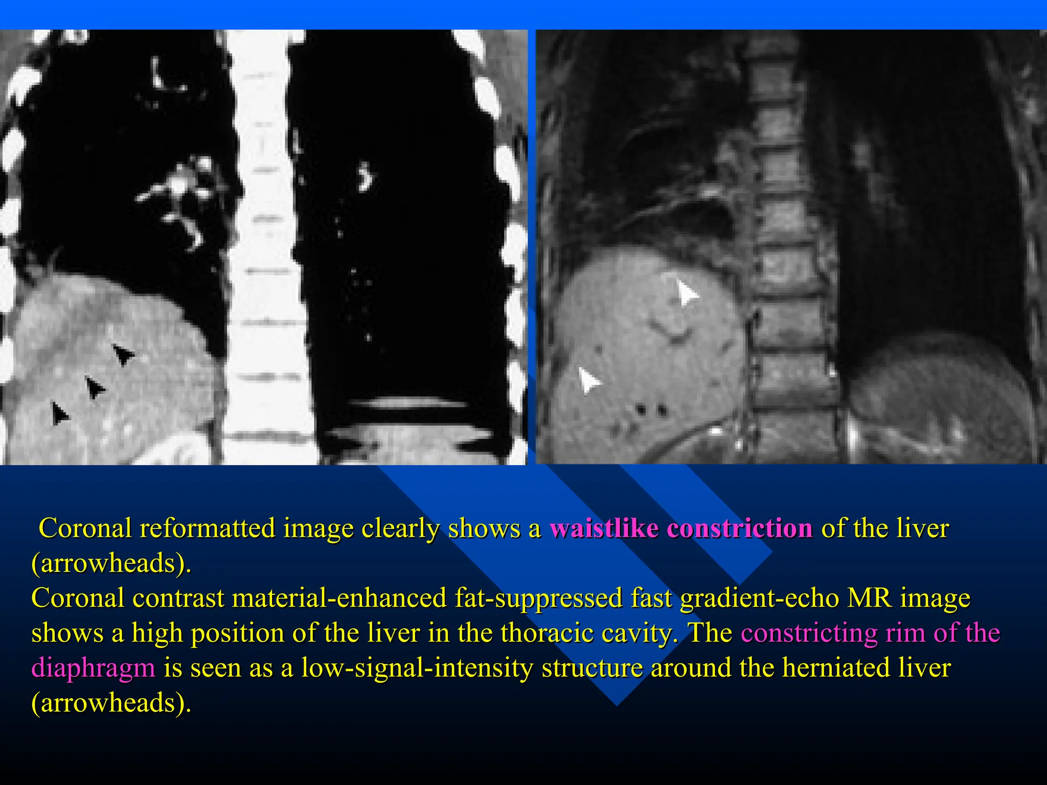 Coronal reformatted image clearly shows a
Coronal reformatted image clearly shows a waistlike constriction
waistlike constriction of the liver
of the liver
(arrowheads).
(arrowheads).
Coronal contrast material-enhanced fat-suppressed fast gradient-echo MR image
Coronal contrast material-enhanced fat-suppressed fast gradient-echo MR image
shows a high position of the liver in the thoracic cavity. The
shows a high position of the liver in the thoracic cavity. The constricting rim of the
constricting rim of the
diaphragm
diaphragm is seen as a low-signal-intensity structure around the herniated liver
is seen as a low-signal-intensity structure around the herniated liver
(arrowheads).
(arrowheads).
 