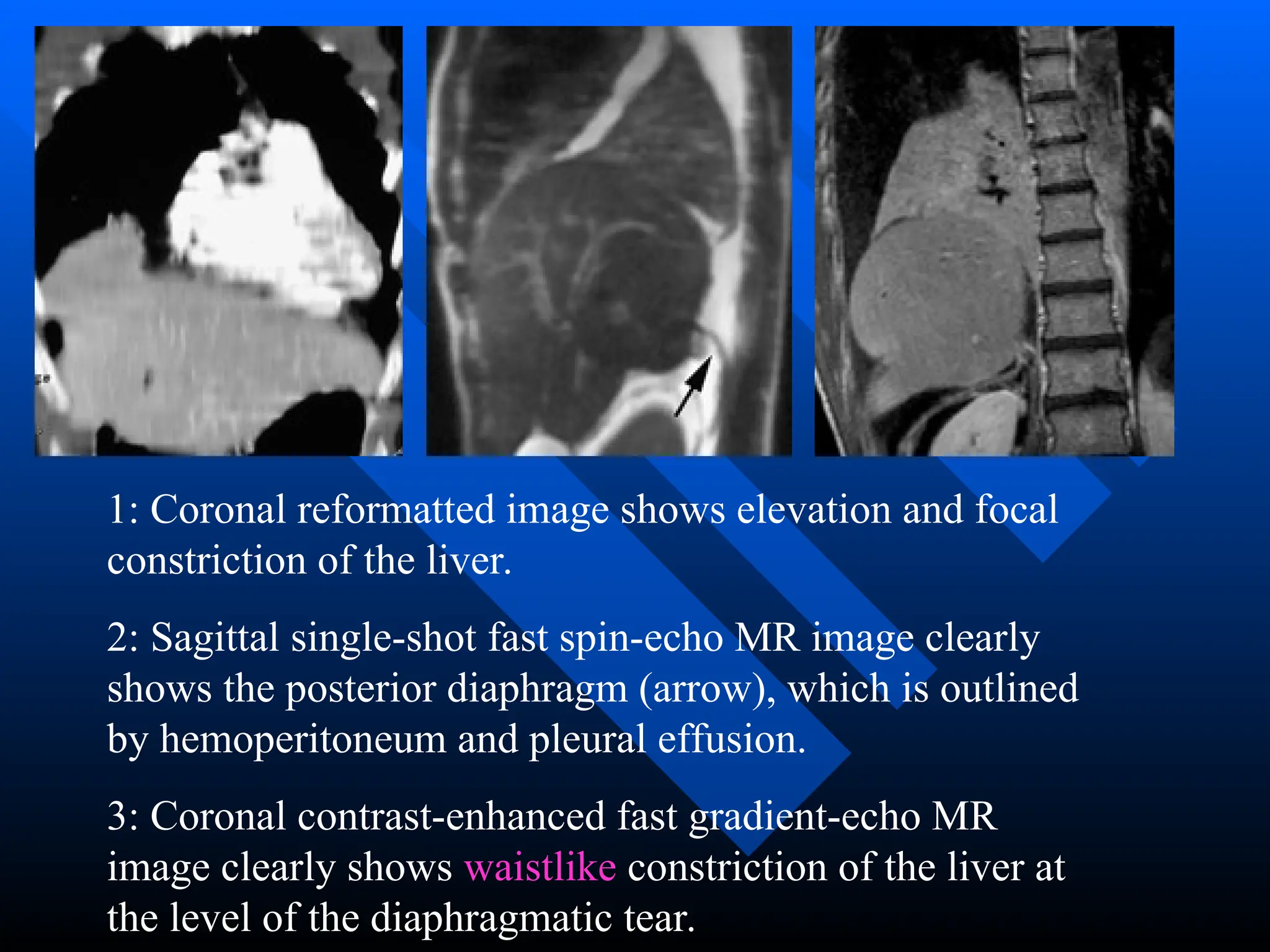 1: Coronal reformatted image shows elevation and focal
constriction of the liver.
2: Sagittal single-shot fast spin-echo MR image clearly
shows the posterior diaphragm (arrow), which is outlined
by hemoperitoneum and pleural effusion.
3: Coronal contrast-enhanced fast gradient-echo MR
image clearly shows waistlike constriction of the liver at
the level of the diaphragmatic tear.
 