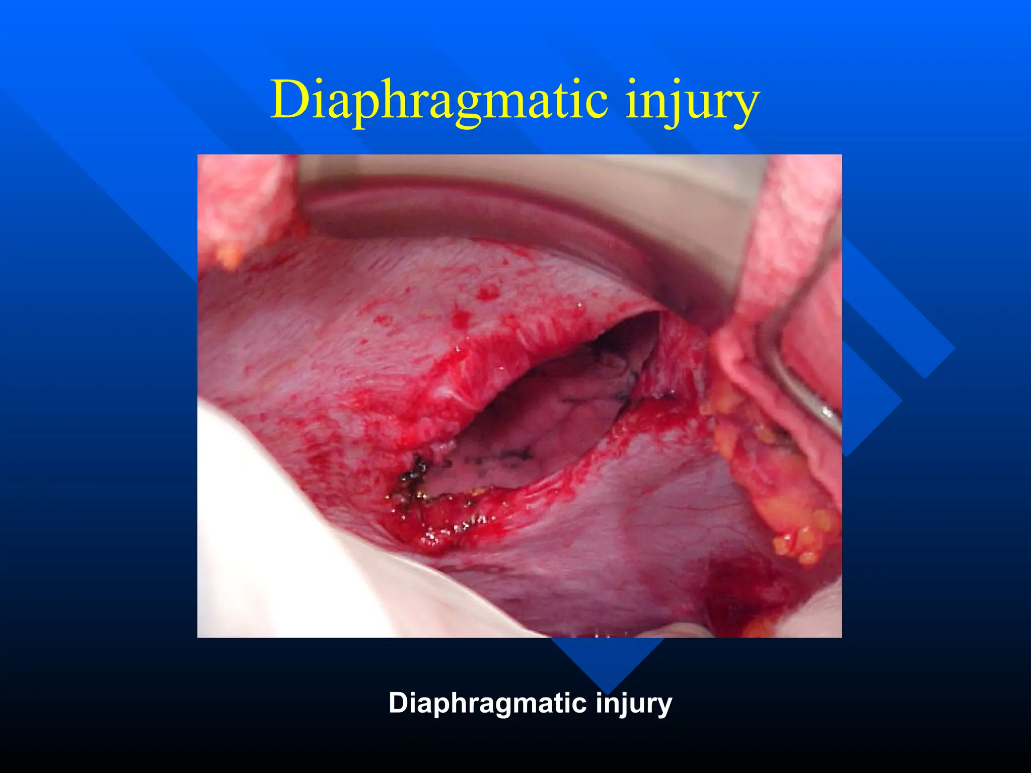 Diaphragmatic injury
Diaphragmatic injury
 