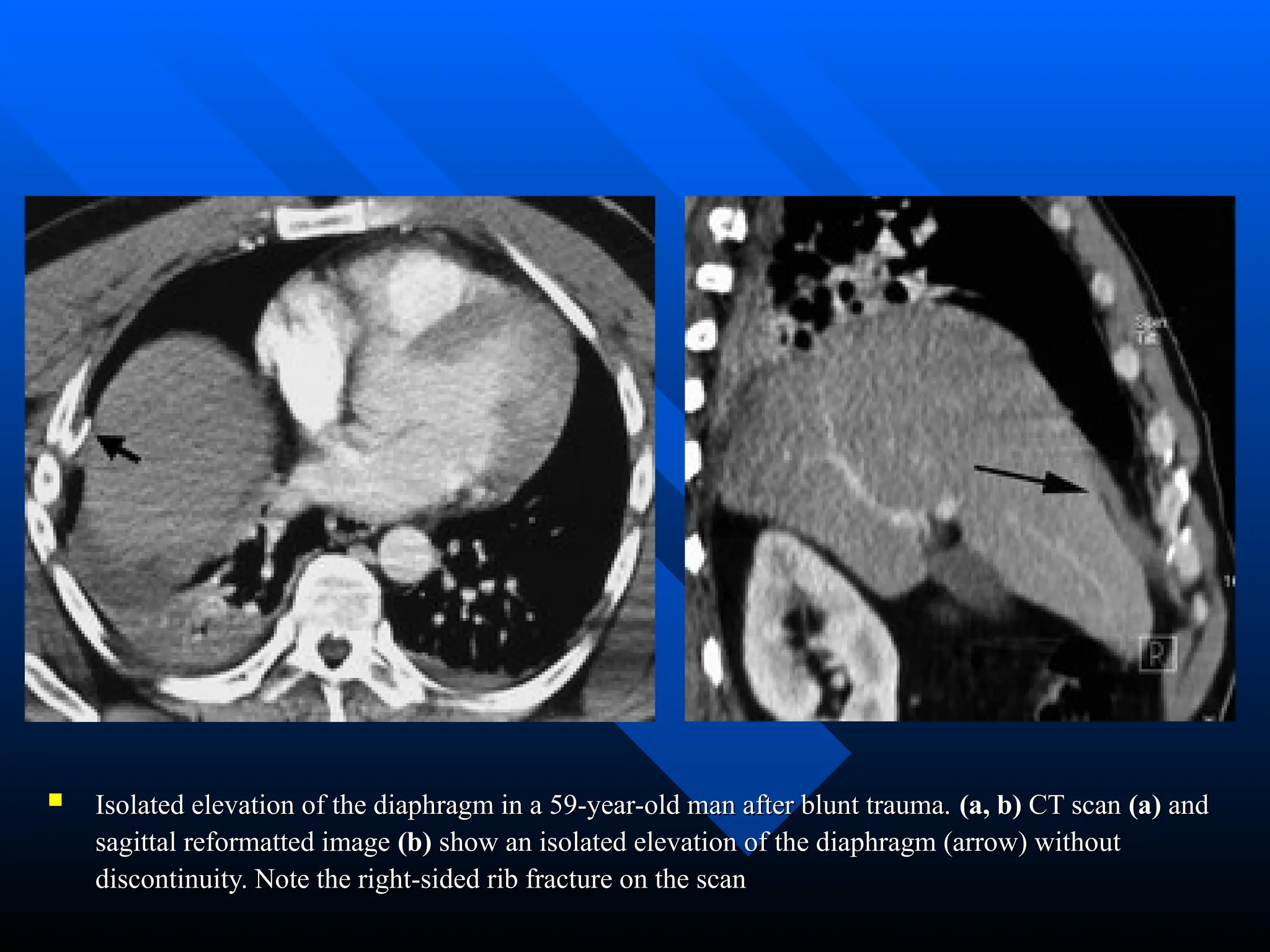  Isolated elevation of the diaphragm in a 59-year-old man after blunt trauma.
Isolated elevation of the diaphragm in a 59-year-old man after blunt trauma. (a, b)
(a, b) CT scan
CT scan (a)
(a) and
and
sagittal reformatted image
sagittal reformatted image (b)
(b) show an isolated elevation of the diaphragm (arrow) without
show an isolated elevation of the diaphragm (arrow) without
discontinuity. Note the right-sided rib fracture on the scan
discontinuity. Note the right-sided rib fracture on the scan
 