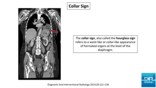Diaphragmatic Injuries - Radiology Reading Room | PPTX