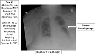 61-Year-Old With A Ruptured Left Hemidiaphragm
Post-Operative CXR
 