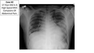 Ruptured Diaphragm
Chest Tube
In The Abdomen
57-Year Old In A High Speed MVC – Now At CMC.
 