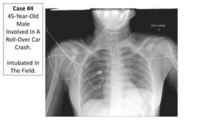 The Left
Hemidiaphragm
Is Indistinct.
Case #5
60-Year Old In
A Motor
Vehicle Crash.
 