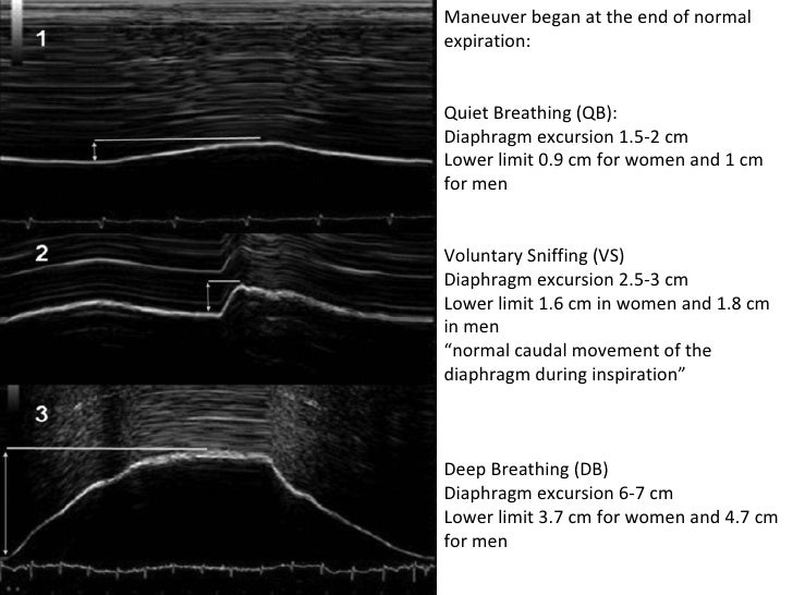 Diaphragm Movement And Contractility Evaluation By Thoracic Ultrasound