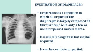 Eventrated Diaphragm_Sara.pptx