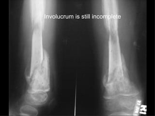 Diaphyseal Sequestrum | PPT