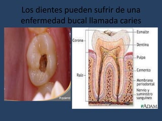Los dientes pueden sufrir de una
enfermedad bucal llamada caries
 
