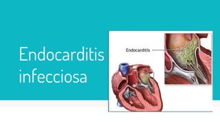 Endocarditis
infecciosa
 