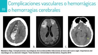 Complicaciones vasculares o hemorrágicas
o hemorragias cerebrales
89
Maisterra Olga. Complicaciones neurológicas de la endocarditis infecciones al inicio del nuevo siglo: Importancia del
neurólogo en su atención integral. Tesis doctoral. Universidad de Barcelona. España 2016
 