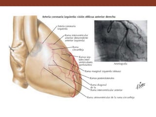 Vasos y nervios del corazón
La arteria coronaria izquierda, Nace de la aorta
inmediatamente superior a la parte media de la valva
semilunar izquierda; alcanza el extremo superior del
surco interventricular anterior y la recorre hasta el
vértice, rodea el vértice del corazón y termina en el
surco interventricular posterior.
La arteria coronaria izquierda proporciona múltiples
colaterales:
• Ramas vasculares destinadas a las paredes resinas
de la aorta y el tronco pulmonar. Entre estas ramas se
distinguen la rama del cono arterial.
• Rama circunfleja se dirige hacia la izquierda y se
introduce en el surco coronario, termina en el extremo
posterior del surco interventricular posterior, donde se
anastomosa con la arteria coronaria derecha en la cara
pulmonar izquierda del corazón. Proporciona ramas al
atrio y al ventrículo izquierdo.
 