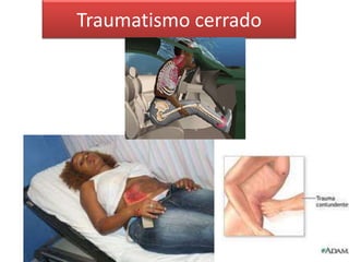 Traumatismo cerrado