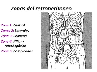 Zonas del retroperitoneoZona 1: CentralZonas 2: LateralesZona 3: PelvianaZona 4: Hiliar -  retrohepáticaZona 5: Combinadas