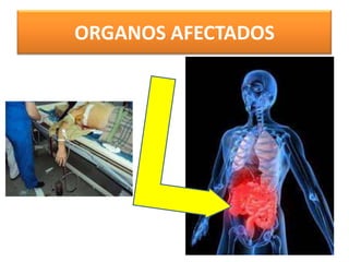 ORGANOS AFECTADOS