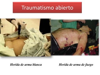 Traumatismo abiertoHerida de arma de fuegoHerida de arma blanca