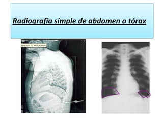 EcografíaLíquido libre abdominal