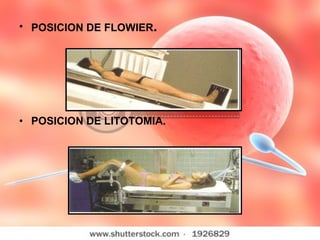 POSICION DE FLOWIER .   POSICION DE LITOTOMIA. 