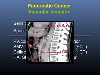 Pancreatic Cancer
Vascular Invasion
Sensitivity:
SpecificityLiver

50-90%

Confluence with PV

90-100%

Stomach
PV/confluence:
EUS superior
SMV: Mass
Equivalent (~CT)
Celiac trunk: Encasement of SMV
Equivalent (~CT)
HA, SMA:
CT superior
SMV

 