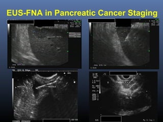 EUS-FNA in Pancreatic Cancer Staging

 