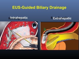 EUS-Guided Biliary Drainage
Intrahepatic
Intrahepatic

Extrahepatic
Extrahepatic

 