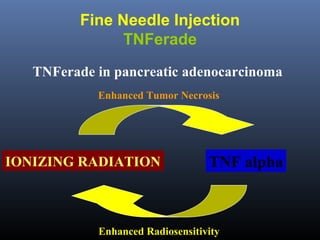 Fine Needle Injection
TNFerade
TNFerade in pancreatic adenocarcinoma
Enhanced Tumor Necrosis

IONIZING RADIATION

TNF alpha

Enhanced Radiosensitivity

 