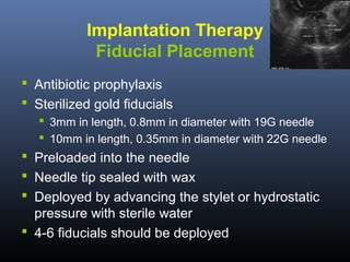 Implantation Therapy
Fiducial Placement
 Antibiotic prophylaxis
 Sterilized gold fiducials
 3mm in length, 0.8mm in diameter with 19G needle
 10mm in length, 0.35mm in diameter with 22G needle

 Preloaded into the needle
 Needle tip sealed with wax
 Deployed by advancing the stylet or hydrostatic
pressure with sterile water
 4-6 fiducials should be deployed

 