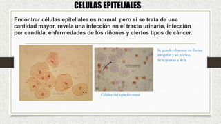 Encontrar células epiteliales es normal, pero si se trata de una
cantidad mayor, revela una infección en el tracto urinario, infección
por candida, enfermedades de los riñones y ciertos tipos de cáncer.
CELULAS EPITELIALES
Se puede observar su forma
irregular y su núcleo.
Se reportan a 40X
Células del epitelio renal
 