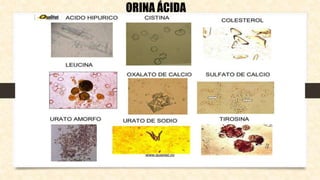 ORINA ÁCIDA
 