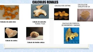 CALCULOS RENALES
 
