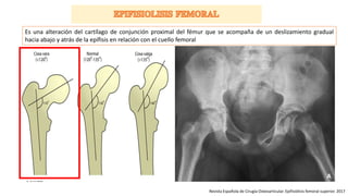 Revista Española de Cirugía Osteoarticular. Epifisiólisis femoral superior. 2017
Es una alteración del cartílago de conjunción proximal del fémur que se acompaña de un deslizamiento gradual
hacia abajo y atrás de la epífisis en relación con el cuello femoral
 