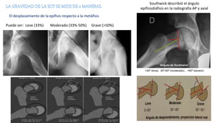 Epifisiolisis Femoral PPTX epifisiolisis-femoral-pptx