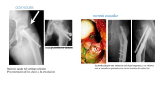 Epifisiolisis femoral | PPTX