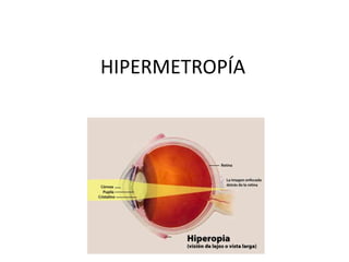 HIPERMETROPÍA
 