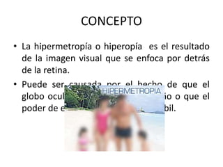 CONCEPTO
• La hipermetropía o hiperopía es el resultado
de la imagen visual que se enfoca por detrás
de la retina.
• Puede ser causada por el hecho de que el
globo ocular es demasiado pequeño o que el
poder de enfoque es demasiado débil.
 