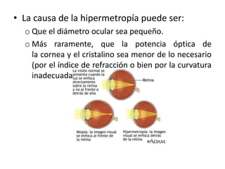 • La causa de la hipermetropía puede ser:
o Que el diámetro ocular sea pequeño.
o Más raramente, que la potencia óptica de
la cornea y el cristalino sea menor de lo necesario
(por el índice de refracción o bien por la curvatura
inadecuada de la córnea).
 