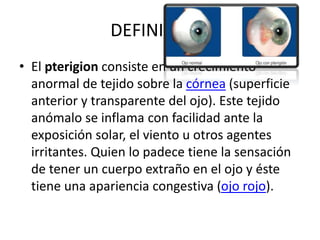 DEFINICION:
• El pterigion consiste en un crecimiento
anormal de tejido sobre la córnea (superficie
anterior y transparente del ojo). Este tejido
anómalo se inflama con facilidad ante la
exposición solar, el viento u otros agentes
irritantes. Quien lo padece tiene la sensación
de tener un cuerpo extraño en el ojo y éste
tiene una apariencia congestiva (ojo rojo).
 